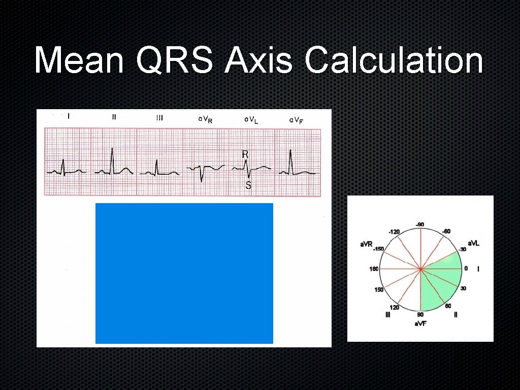 Mean QRS Axis Calculation 