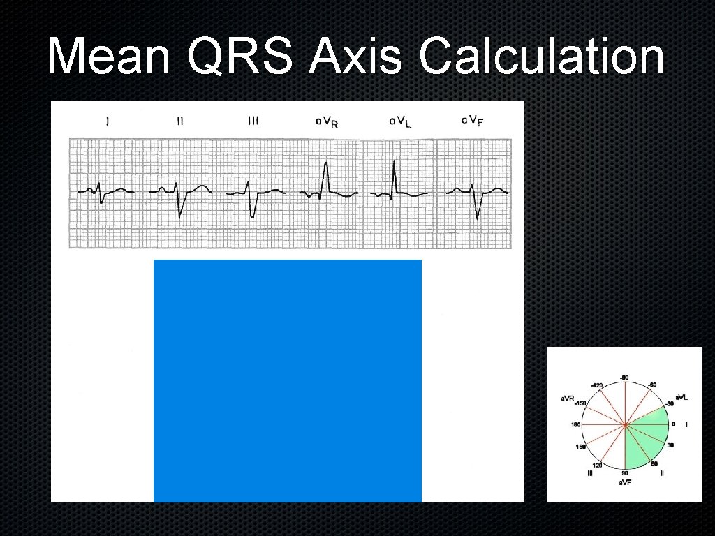 Mean QRS Axis Calculation 