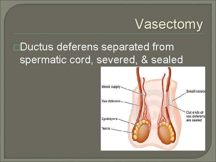 Vasectomy �Ductus deferens separated from spermatic cord, severed, & sealed 