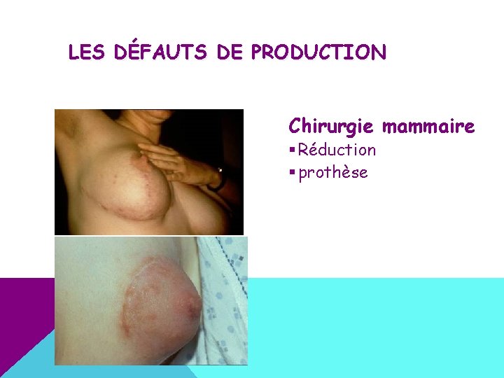 LES DÉFAUTS DE PRODUCTION Chirurgie mammaire § Réduction § prothèse 