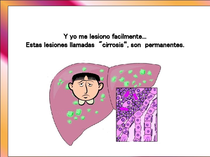 Y yo me lesiono facilmente. . . Estas lesiones llamadas "cirrosis“, son permanentes. Y yo me lesiono facilmente. . . Estas lesiones llamadas "cirrosis“, son permanentes.