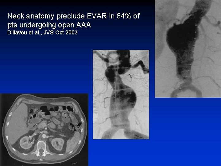 Neck anatomy preclude EVAR in 64% of pts undergoing open AAA Dillavou et al.