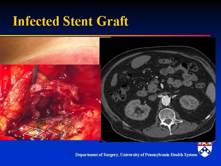 Infected Stent Graft § Uncommon but incidence may be increasing Department of Surgery, University