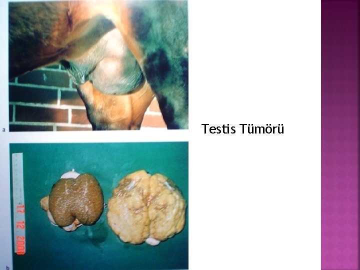 Testis Tümörü 