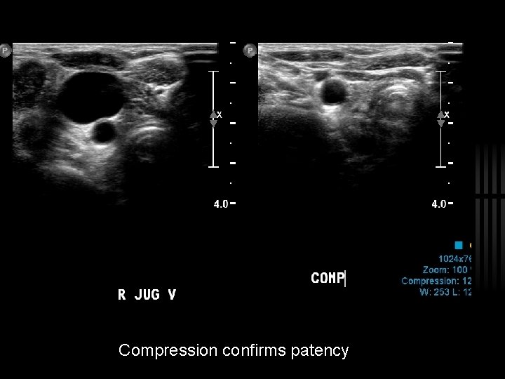 Compression confirms patency 