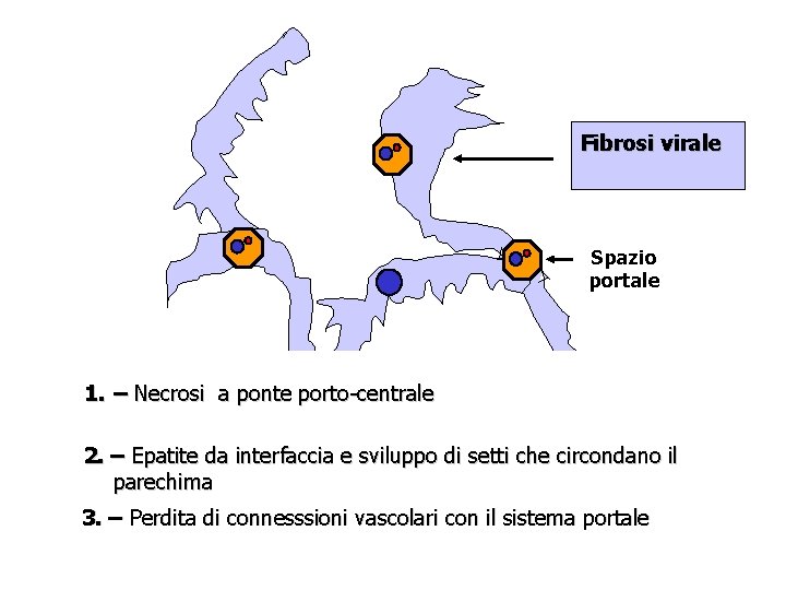 Fibrosi virale Spazio portale 1. – Necrosi a ponte porto-centrale 2. – Epatite da