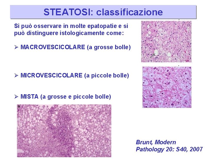 STEATOSI: classificazione Si può osservare in molte epatopatie e si può distinguere istologicamente come: