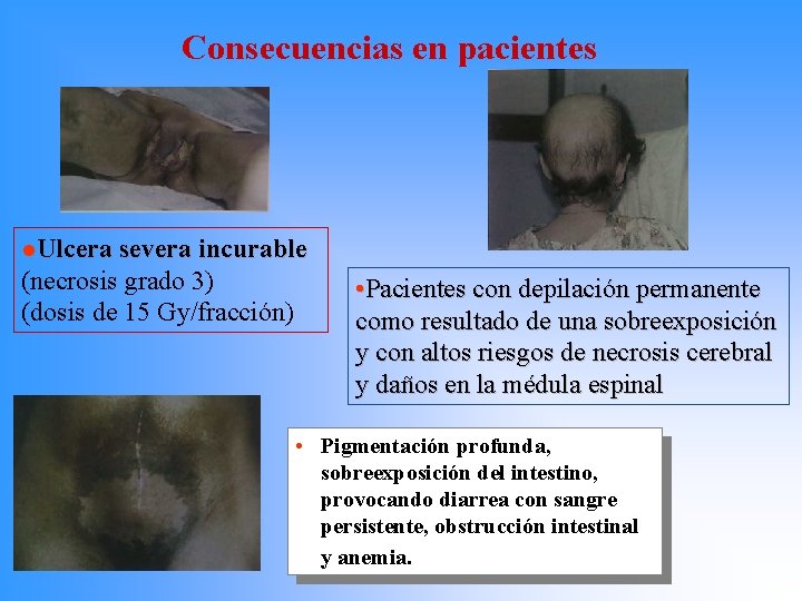 Consecuencias en pacientes l. Ulcera severa incurable (necrosis grado 3) (dosis de 15 Gy/fracción)