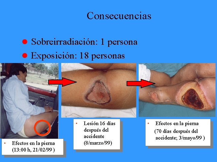 Consecuencias l Sobreirradiación: 1 persona l Exposición: 18 personas • • Efectos en la