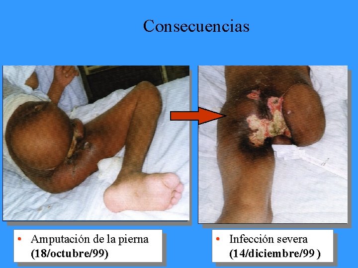 Consecuencias • Amputación de la pierna (18/octubre/99) • Infección severa (14/diciembre/99 ) 