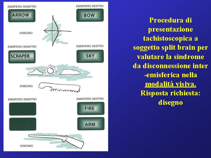 Procedura di presentazione tachistoscopica a soggetto split brain per valutare la sindrome da disconnessione