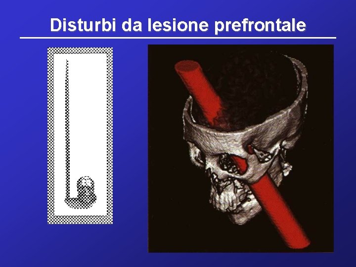 Disturbi da lesione prefrontale 