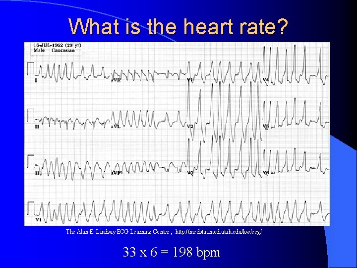 What is the heart rate? The Alan E. Lindsay ECG Learning Center ; http: