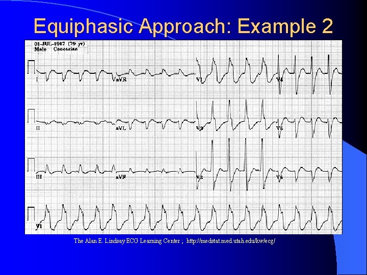 Equiphasic Approach: Example 2 The Alan E. Lindsay ECG Learning Center ; http: //medstat.