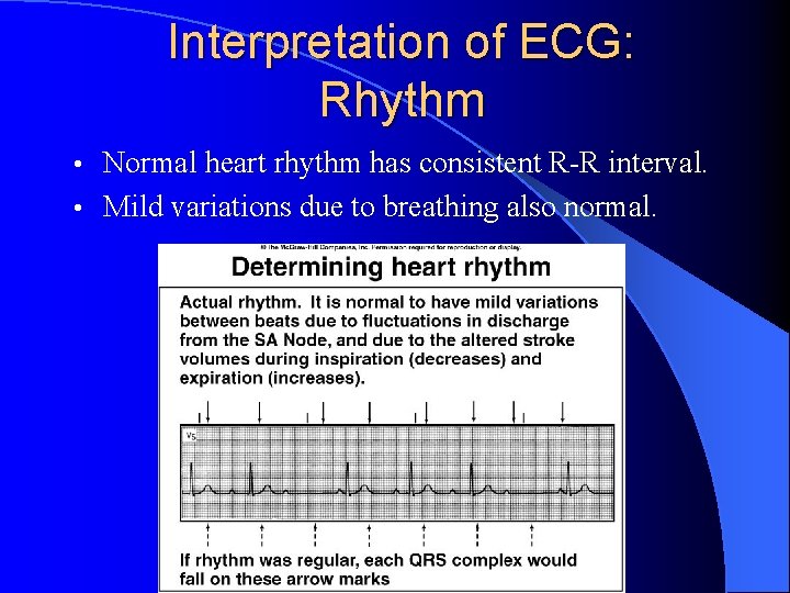 Interpretation of ECG: Rhythm Normal heart rhythm has consistent R-R interval. • Mild variations