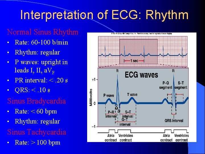 Interpretation of ECG: Rhythm Normal Sinus Rhythm • • • Rate: 60 -100 b/min