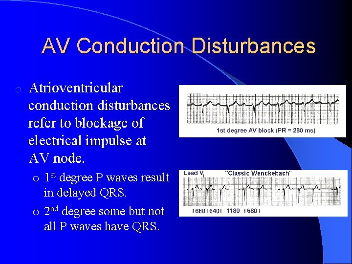AV Conduction Disturbances o Atrioventricular conduction disturbances refer to blockage of electrical impulse at