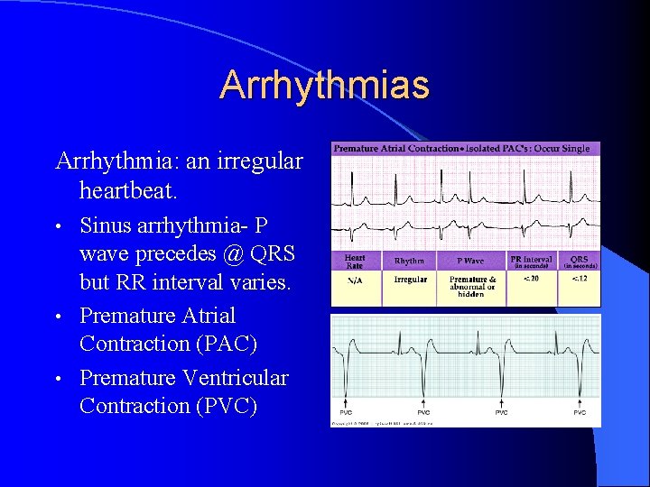 Arrhythmias Arrhythmia: an irregular heartbeat. Sinus arrhythmia- P wave precedes @ QRS but RR