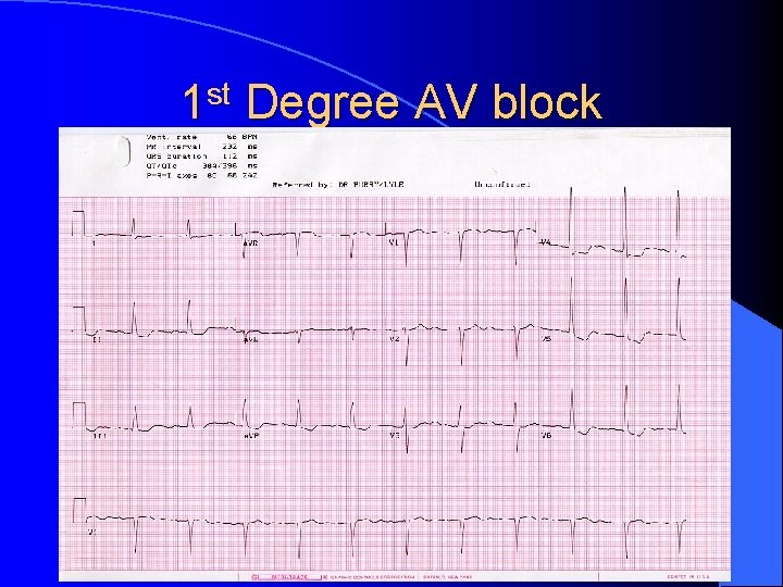 1 st Degree AV block 