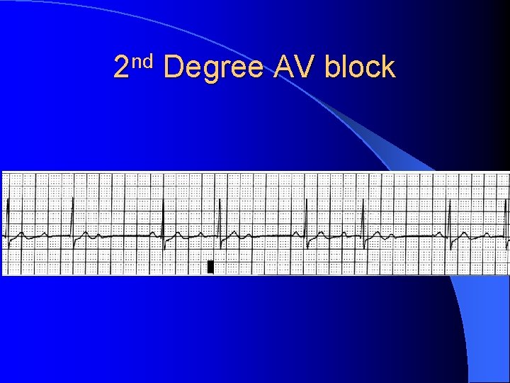 2 nd Degree AV block 