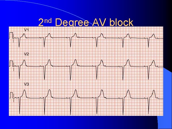 2 nd Degree AV block 