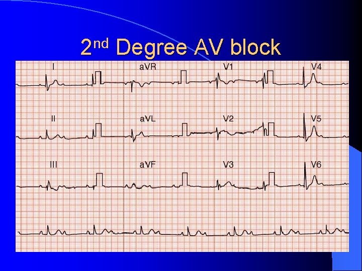 2 nd Degree AV block 