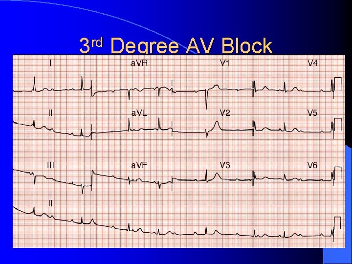 3 rd Degree AV Block 