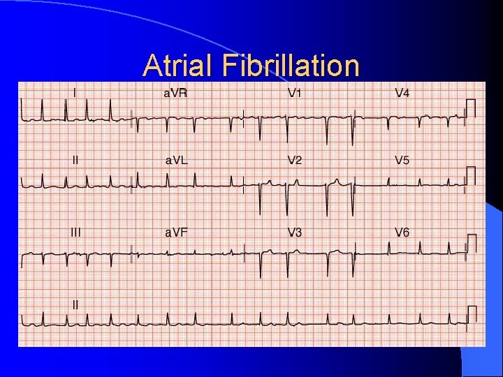 Atrial Fibrillation 