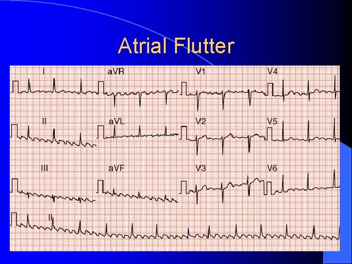 Atrial Flutter 