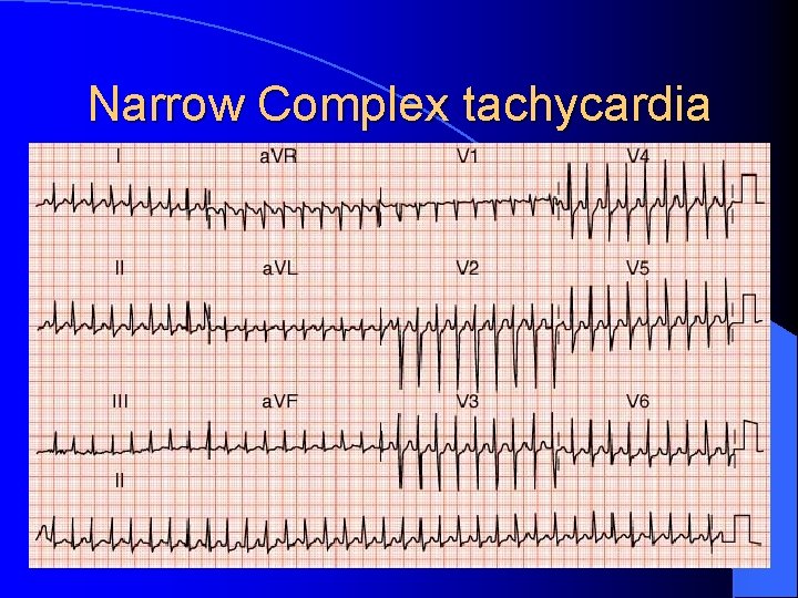Narrow Complex tachycardia 