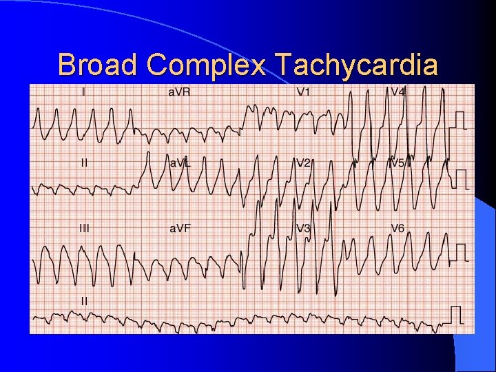 Broad Complex Tachycardia 