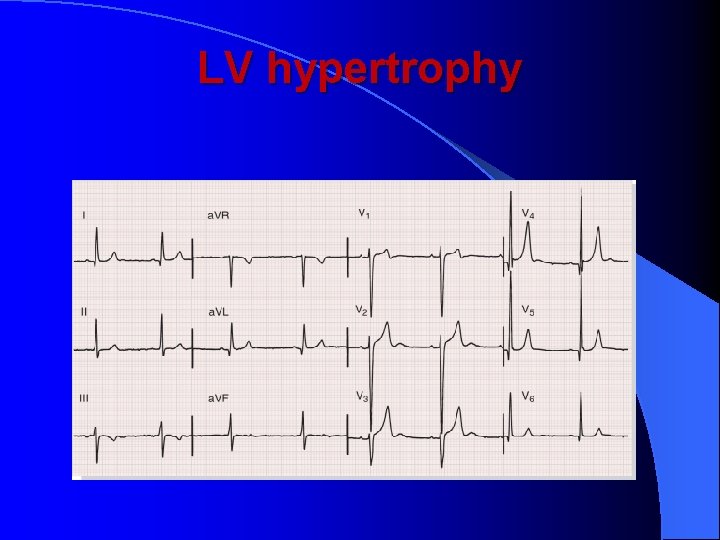 LV hypertrophy 