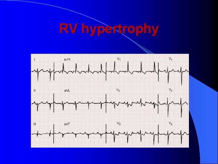 RV hypertrophy 