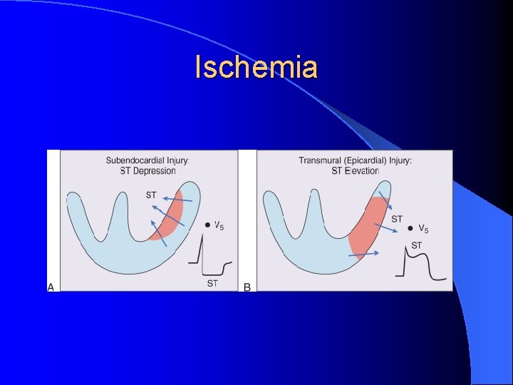 Ischemia 