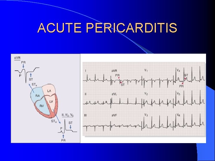 ACUTE PERICARDITIS 