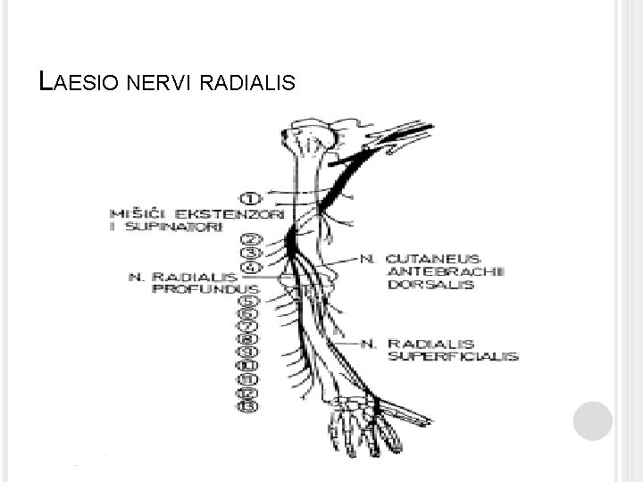LAESIO NERVI RADIALIS LAESIO NERVI RADIALIS
