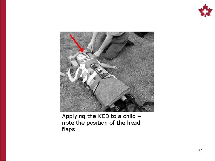 Applying the KED to a child – note the position of the head flaps