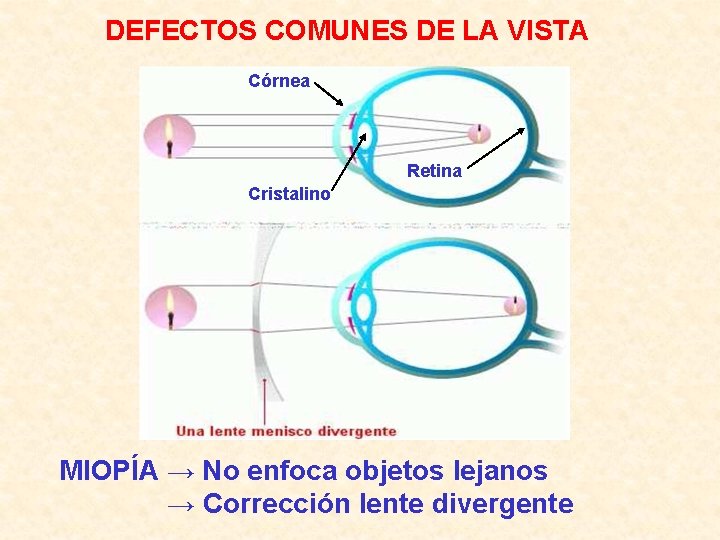 DEFECTOS COMUNES DE LA VISTA Córnea Retina Cristalino MIOPÍA → No enfoca objetos lejanos DEFECTOS COMUNES DE LA VISTA Córnea Retina Cristalino MIOPÍA → No enfoca objetos lejanos