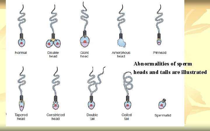Abnormalities of sperm heads and tails are illustrated 