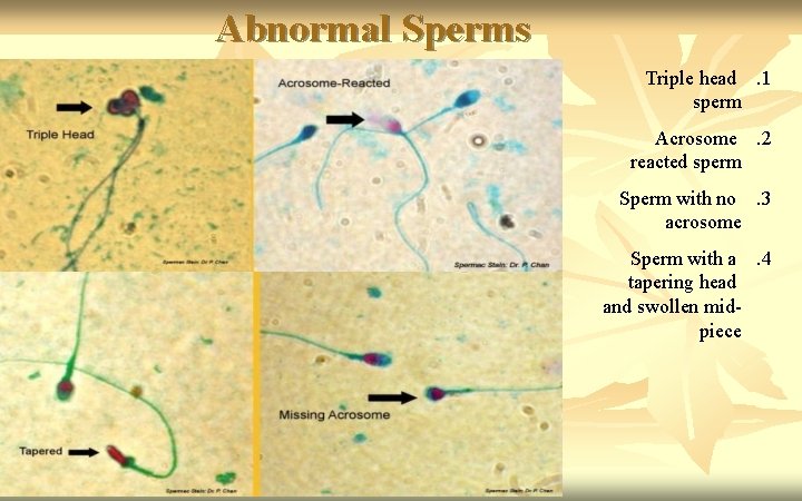 Abnormal Sperms Triple head. 1 sperm Acrosome. 2 reacted sperm Sperm with no. 3