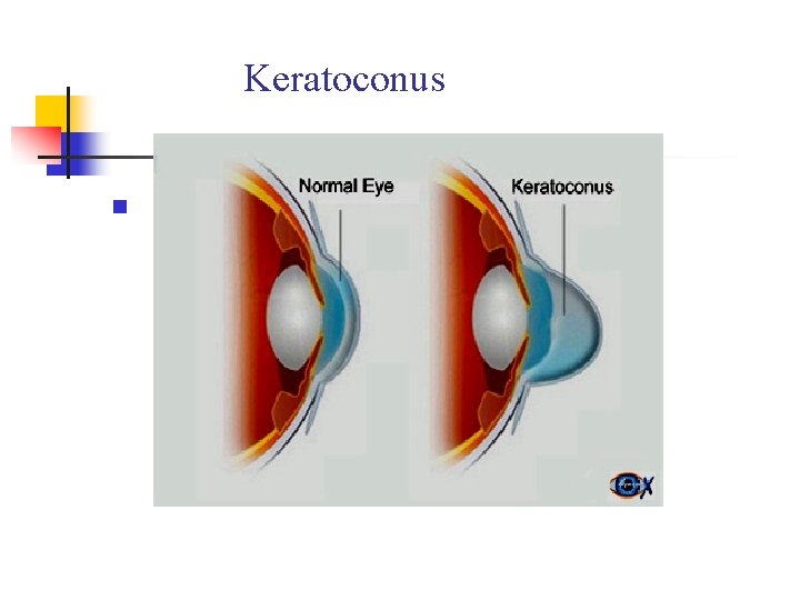 Keratoconus n 