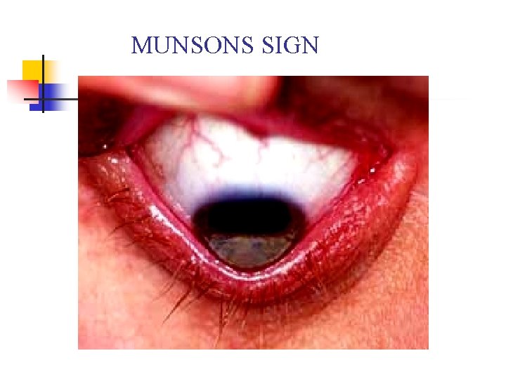 MUNSONS SIGN 