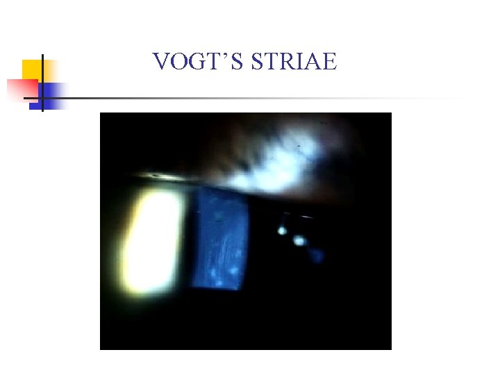 VOGT’S STRIAE 