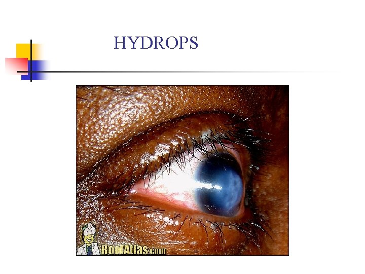 HYDROPS 