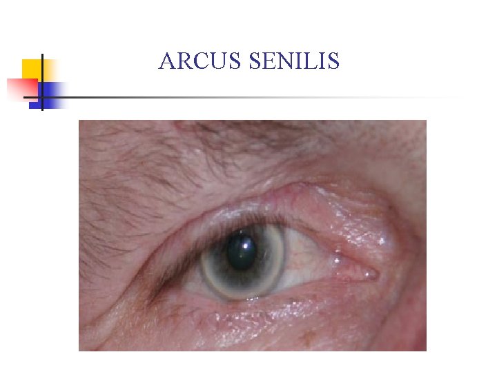 ARCUS SENILIS 