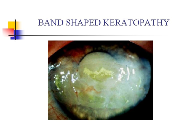 BAND SHAPED KERATOPATHY 