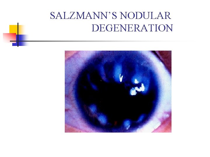 SALZMANN’S NODULAR DEGENERATION 