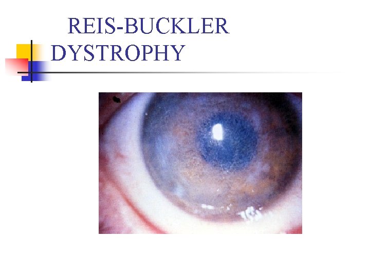 REIS-BUCKLER DYSTROPHY 