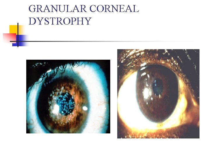 GRANULAR CORNEAL DYSTROPHY 