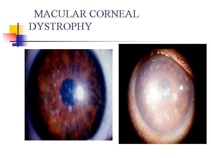 MACULAR CORNEAL DYSTROPHY 